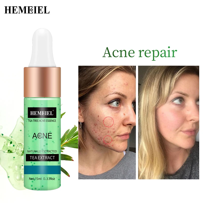HEMEIEL Tea Tree Acne Essence Naturally Extracted Acne Treatment Face