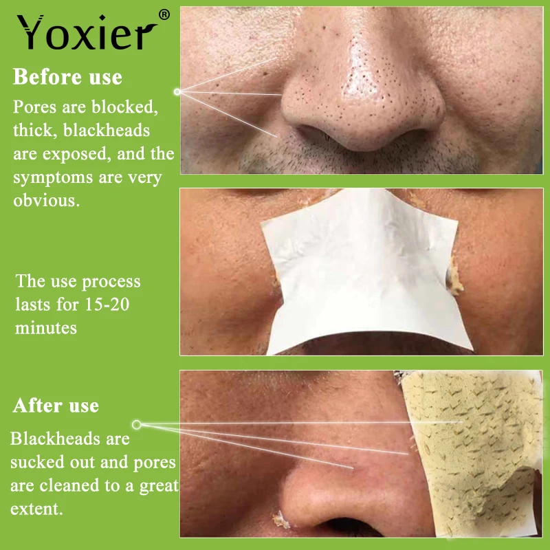Yoxier Remove Blackhead Acne Nose Peeling Fabric Mask Skin Care Pore Strip Black Shill For Acne 1 Yoxier Remove Blackhead Acne Nose Peeling Fabric Mask Skin Care Pore Strip Black Shill For Acne 4