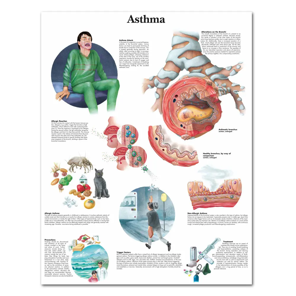 

WANGART Asthma Chart Poster Print Canvas Painting Wall Pictures for Medical Education Doctors Office Classroom no frame