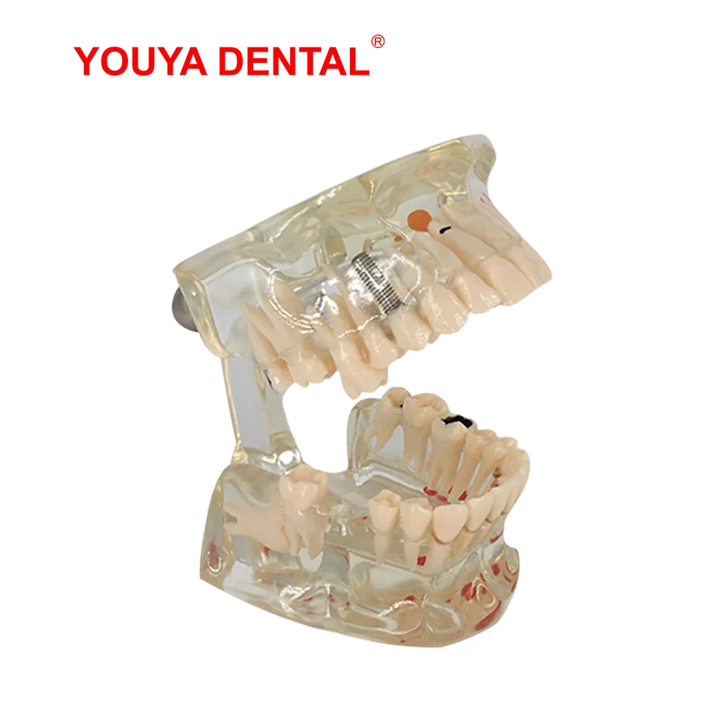 Tanio Model dentystyczny z brakującym zębem przezroczysty patologia Model zębów