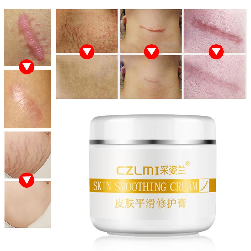 

Removal Scar Cream Face Pimples Scar Stretch Marks Removal Acne Treatment Whitening Moisturizing Cream Skin Care TSLM1