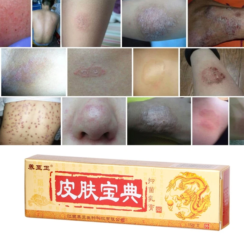 Natural Chinese Medicine Herbal Anti Bacteria Cream Psoriasis Eczema Ointment Treatment 3