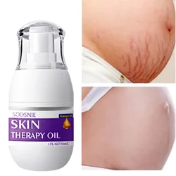 30g Stretch Marks Remover Essential Oil Skin Care Treatment Cream For Stretch Mark Removal Maternity Slackline For Pregnant Oils
