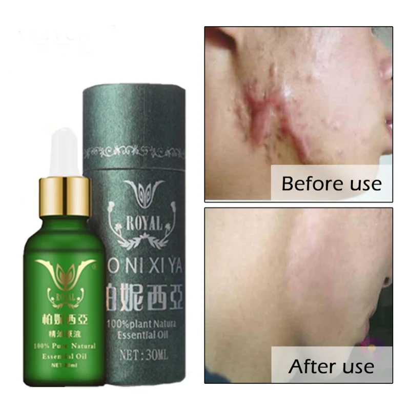 Face Care Essential Oil Acne Scar Spots Removal Skin Care Whitening Remove Scars Acne Repair Face 1 Face Care Essential Oil Acne Scar Spots Removal Skin Care Whitening Remove Scars Acne Repair Face 1