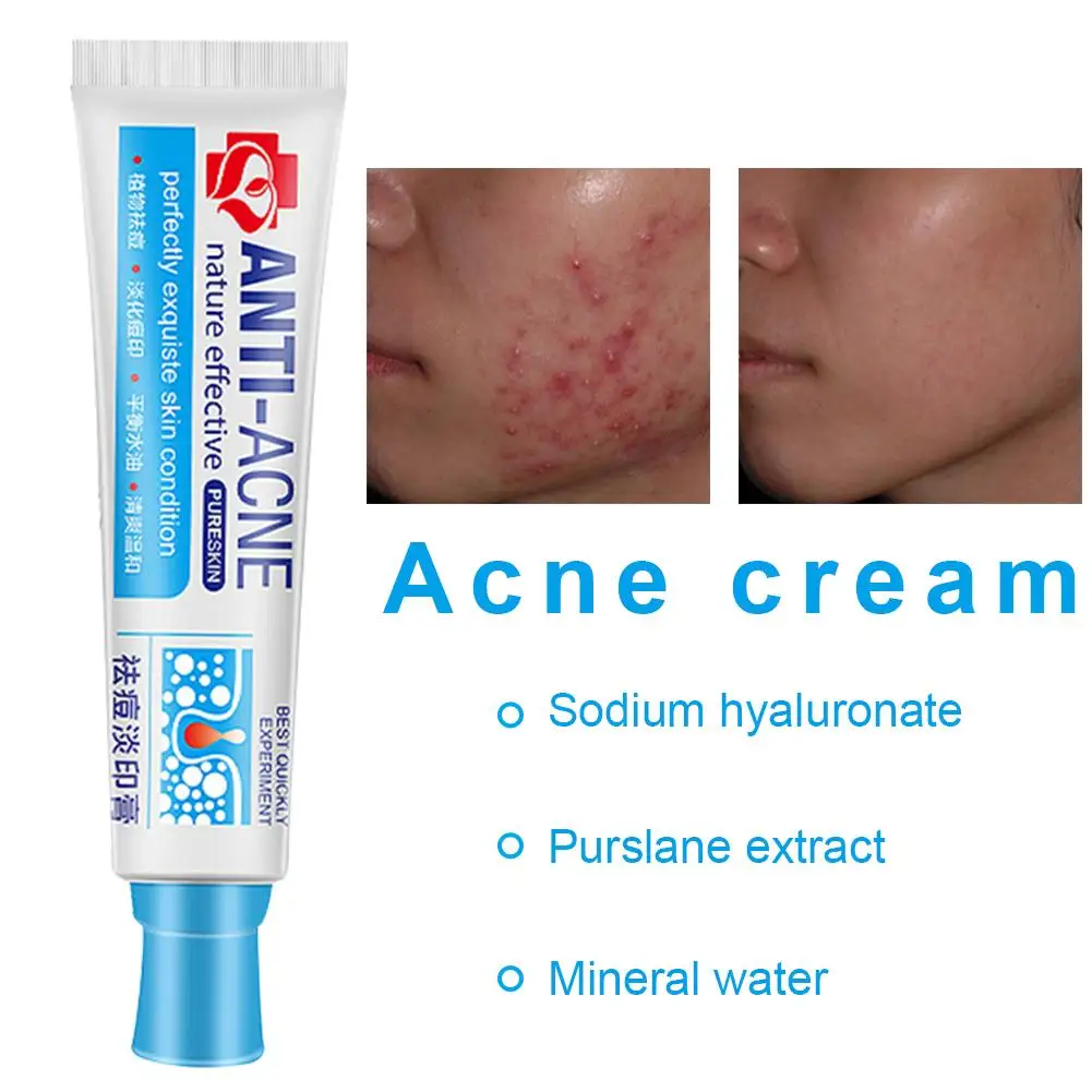 

Acne Mark Removal Cream Acne Treatment Blackhead Anti Acne Cream Oil Control Shrink Pores Acne Scar Remove Face Care Whitening