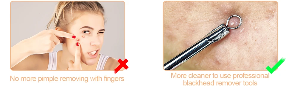 Blackhead Remover Pimple Popper Tool Kit 2
