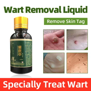 

Genital Warts Remove Antibacterial Liquid Medical Treatment Flat Wart or Foot Calluses Pain Relief Quick Removal Foot Corn Warts