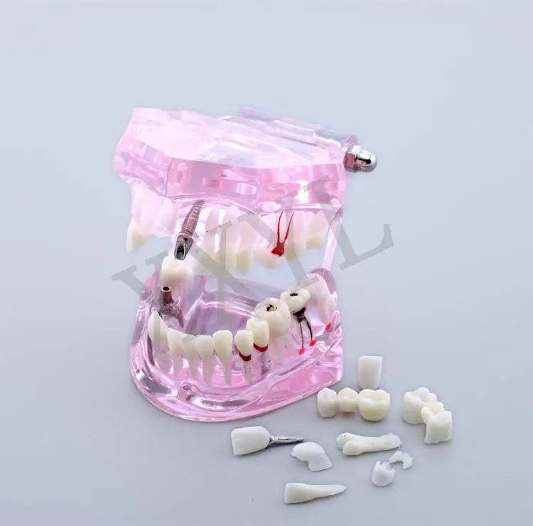 Стоматологическая модель исследования учат патологии демонстрационная модель зубов 1 шт. Розовая модель