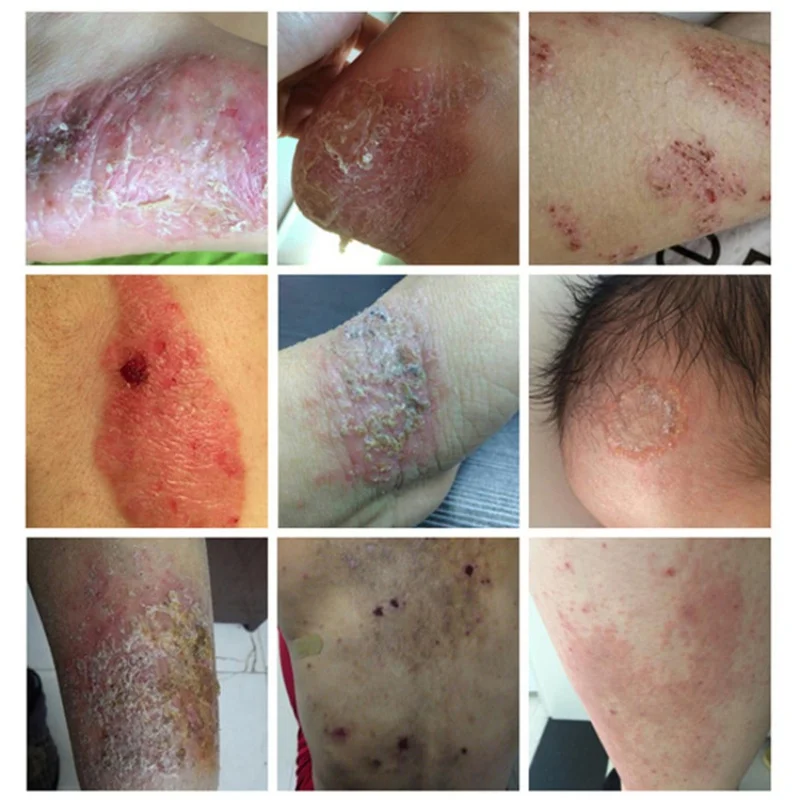 Psoriasis Cream Skin Care Dermatitis Eczematoid Eczema Ointment Treatment Anti Fungal Chinese Herbal Body Psoriasis Cream