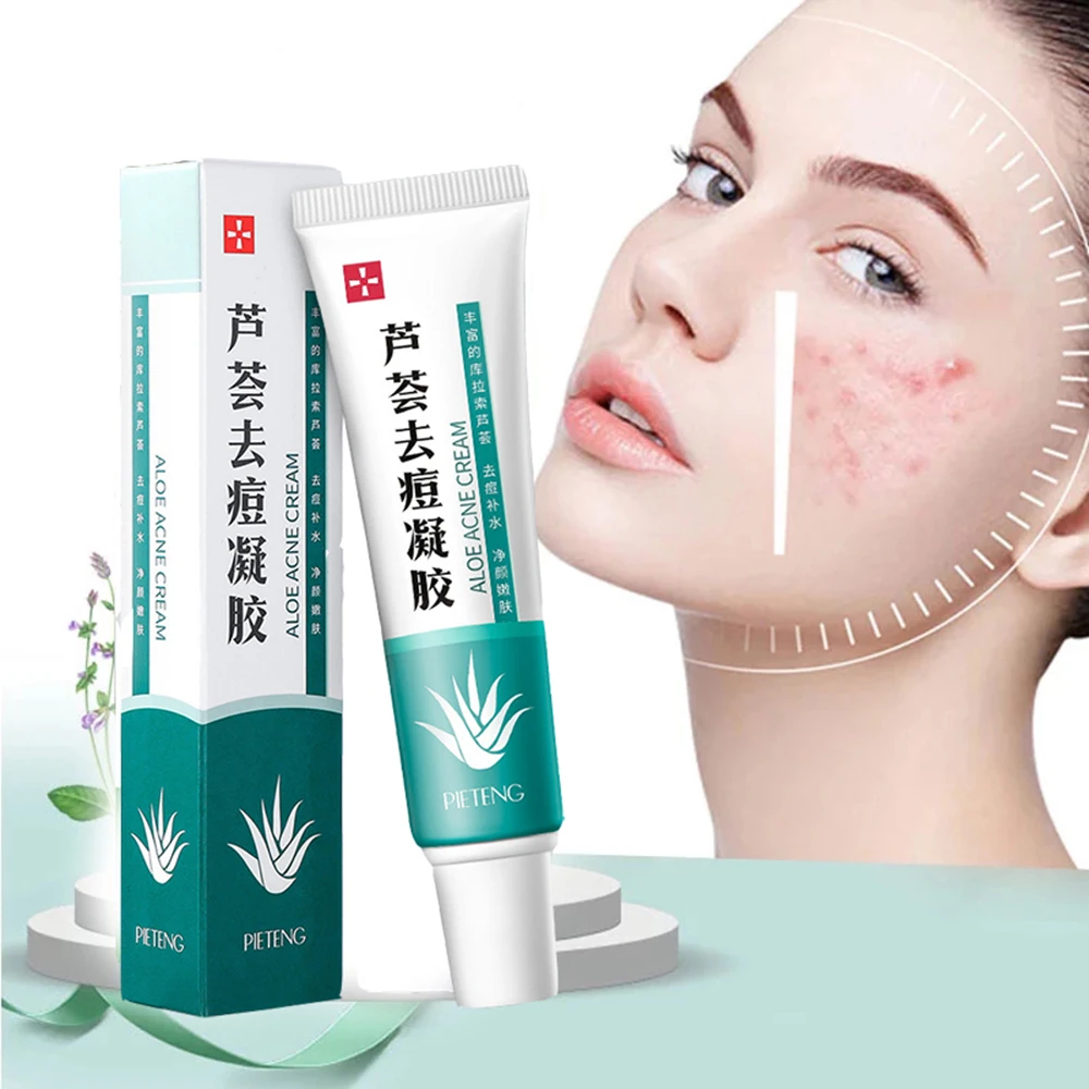 Effective Acne Removal Cream Acne Treatment Fade Acne Spots Oil Control Shrink P…