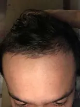 Cuidado del cabello para el crecimiento del cabello aceites esenciales esencia Original auténtico 100% pérdida de cabello líquido salud belleza suero denso para el crecimiento del cabello