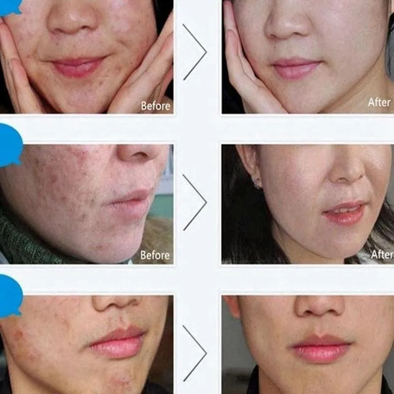 H97e1bf79a6e74efbb0d49db39a2a8427R pro.w Whitening Face Cream From Acne On Face Remove Melasma Remove Dark Spots Pigment Melanin Brightening Cream From Acne