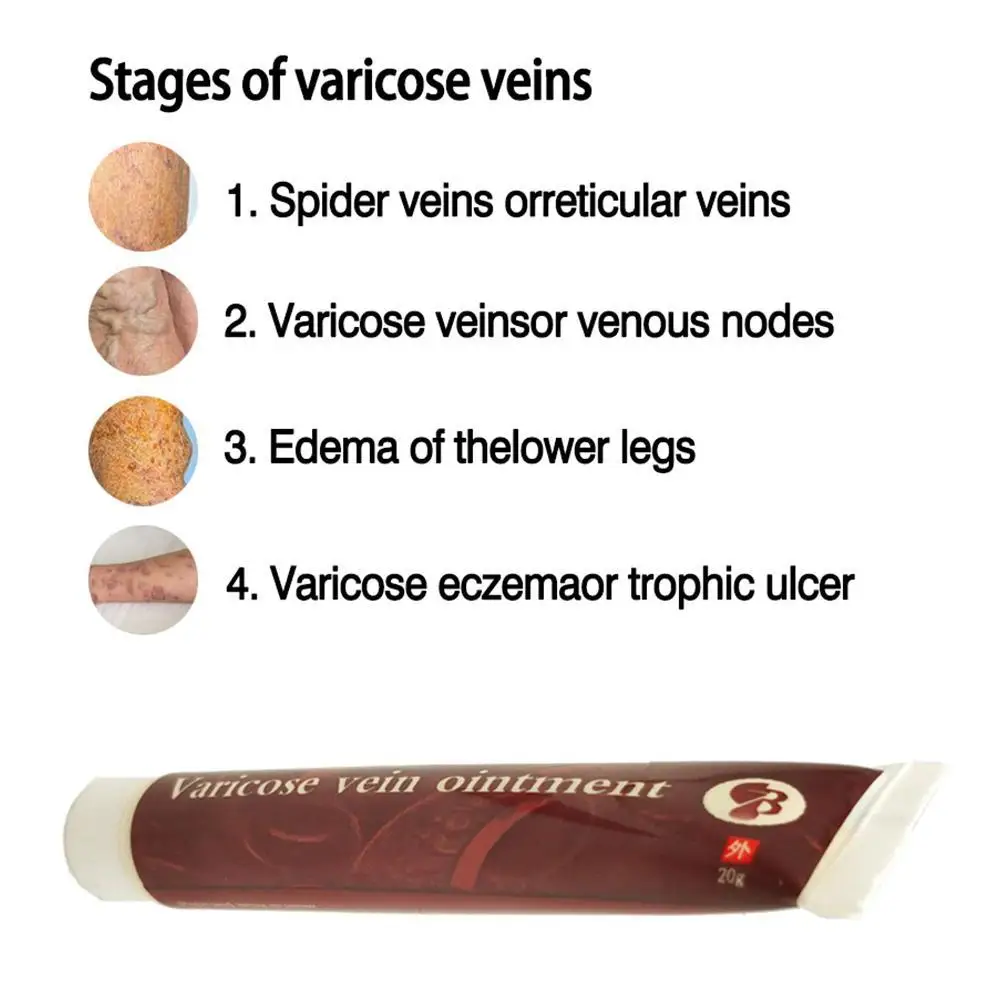 Полезное лечение Варикозного расширения вен крем эффективное лечение васкулит фалебит паук вены боль вариксия ангиит пластырь с узорами