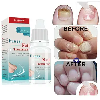

Herbs Fungal Nail Treatment Toe Nail Fungus Removal Whitening Anti Care Nail Bright Infection Gel Feet Foot Z7K9