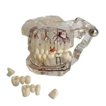 Модель зуба из смолы Стоматологическое заболевание имплантат зубов Модель с восстановлением мост палочки для очистки зубов для медицинские товары болезни обучения