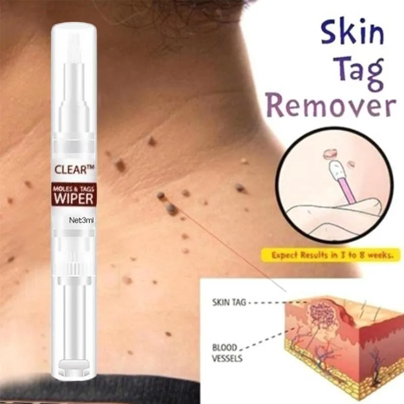 3ml Wipe Off Tags &amp Moles Pen For Callus Gram Warts Foot Remover Liquid Genital Wart Removal Treatment Skin Beauty | Красота и