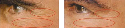 Argireline/Hyaluronic Acid / Matrixyl 3000