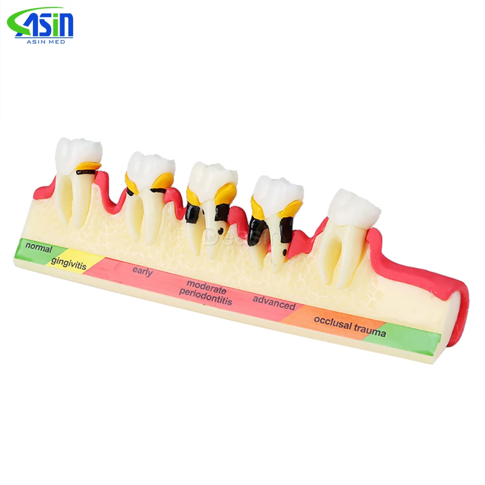 

Oral Teeth Model Periodontal Disease Model Teeth Pathology Model Medical Teaching Aids Dentist Teaching Equipment
