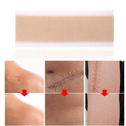 실리콘 흉터 패치 시트, 외상 화상 흉터 시트, 피부 복구, 흉터 제거 치료 패치, 실리콘 여드름 흉터 치료 4