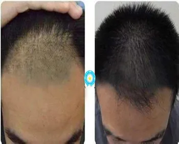 

10mg Tripeptide, hair growth peptide, cosmetic material, hair growth prevention, hair loss prevention