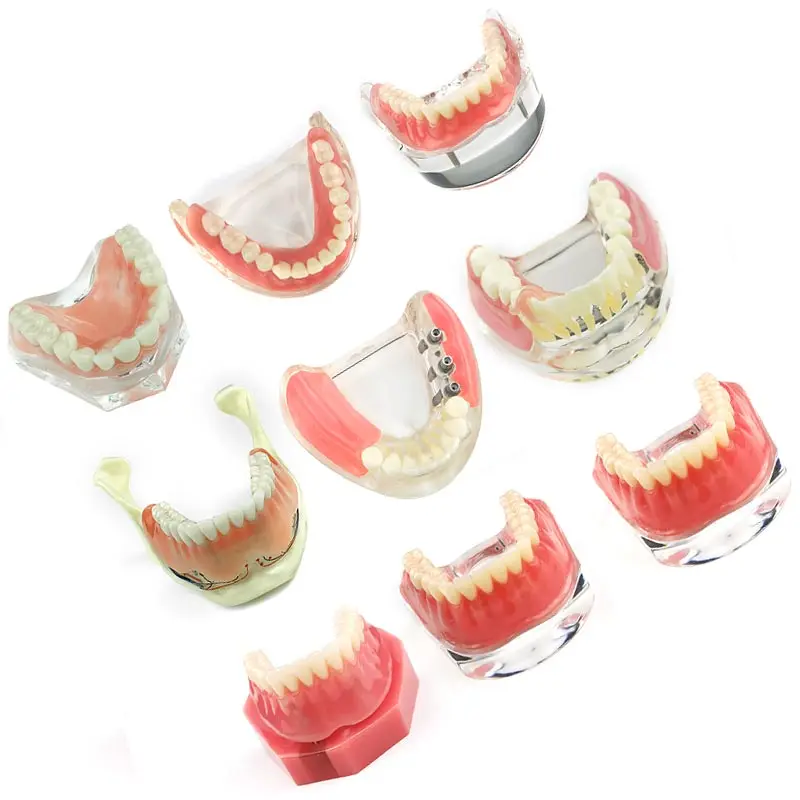 

Dental Overdenture Teeth Dental Implant Teeth Model Demo Overdenture Restoration with Implants Upper