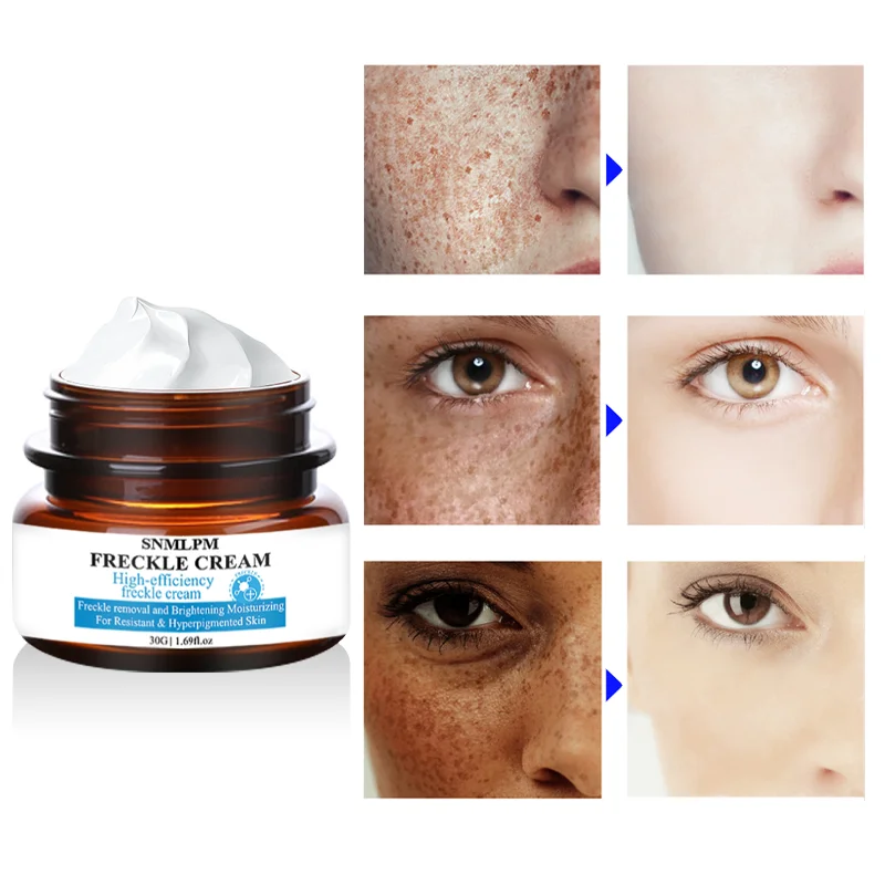 snmlpm freckle cream