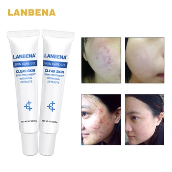 

LANBENA Acne Treatment Gel Acne Cleaning Cream Blackhead Remover Acne Spots Face Acne Scars Repair Comedone Pimple 2PCS