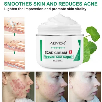 

Scar Removal Stretch Marks Cream Natural Herbal Anti Acne Pocks Treatment Face Cream Whitening Facial Factor Hot