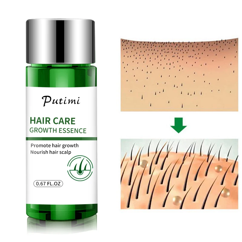 Putimi 20ml Ginger Hair Loss Essence Effective Dense Hair Growth Essence Serum Preventing Baldness Care Serum for Women Men