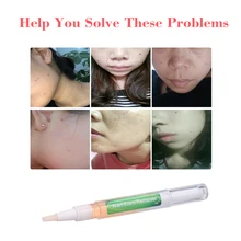 3 мл бородающая ручка для удаления согревающей кукурузы лечение инфекций для ремонта ног целебные мозоли согревающая ручка для удаления