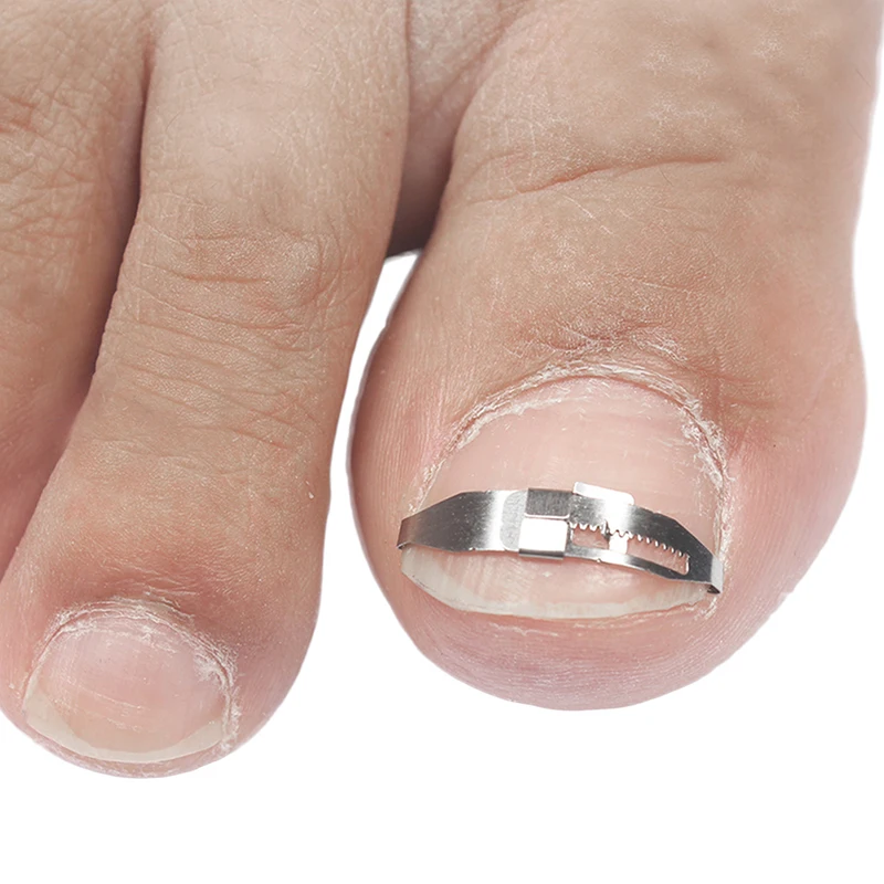 1Pc Stainless Steel Ingrown Toe Nail Correction Pedicure Tool Patch Fixer Recover Corrector Nail File Foot Care Tool 1Pc Stainless Steel Ingrown Toe Nail Correction Pedicure Tool Patch Fixer Recover Corrector Nail File Foot Care Tool