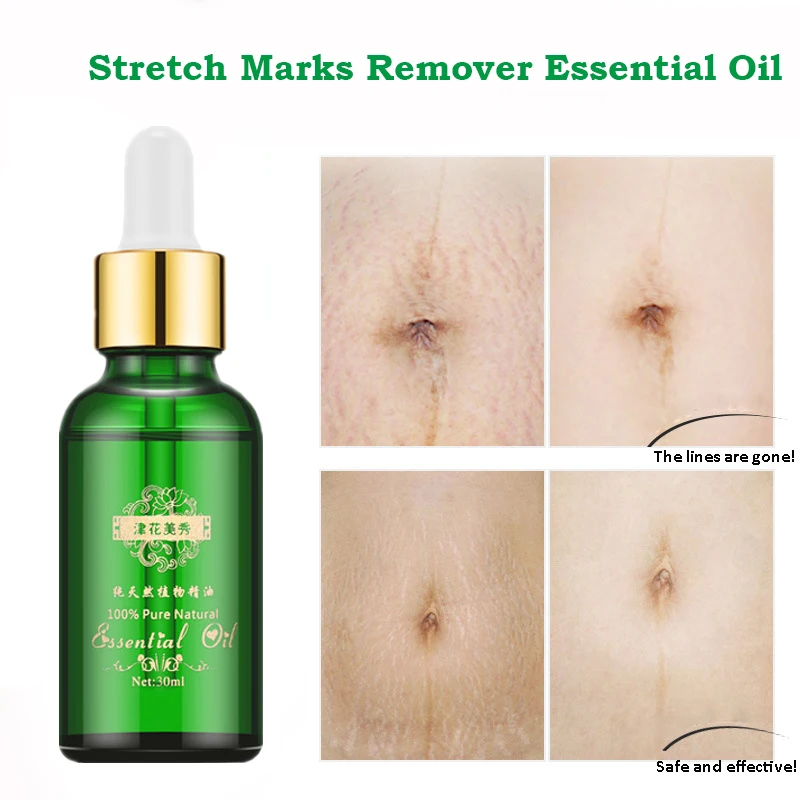 

Stretch Marks Remover Essential Oil Skin Care Treatment Cream For Stretch Mark Removal Maternity Slackline For Pregnant Oils