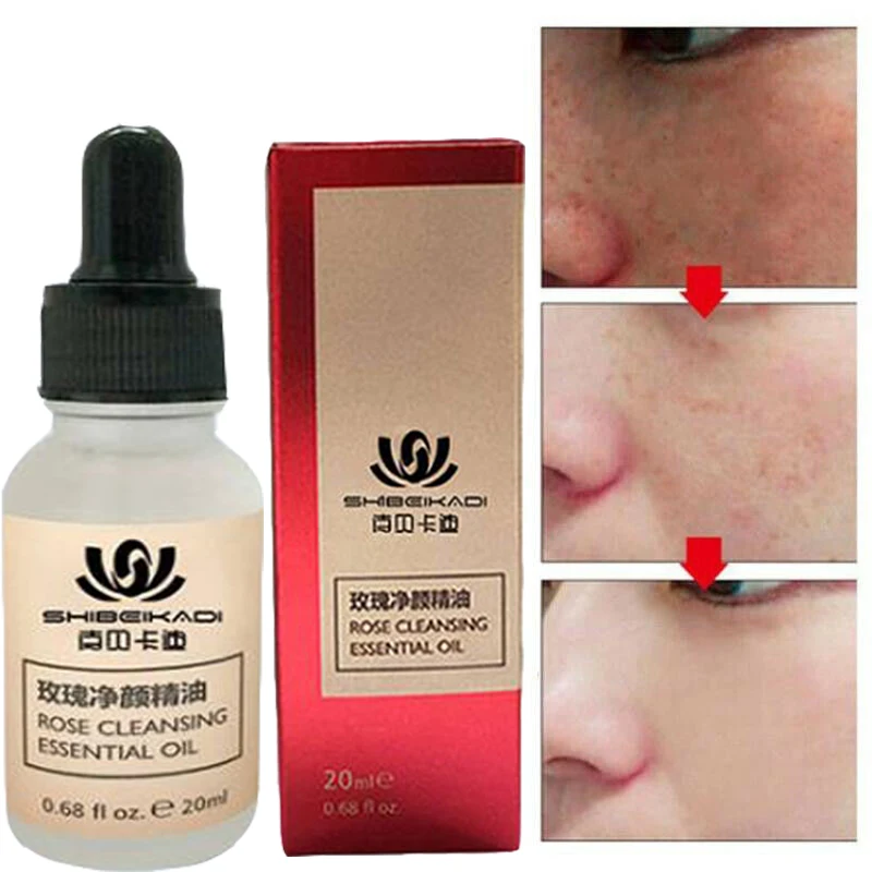 

Effectively remove freckles, freckles, chloasma, facial removal essence, cream, moisturizing and whitening