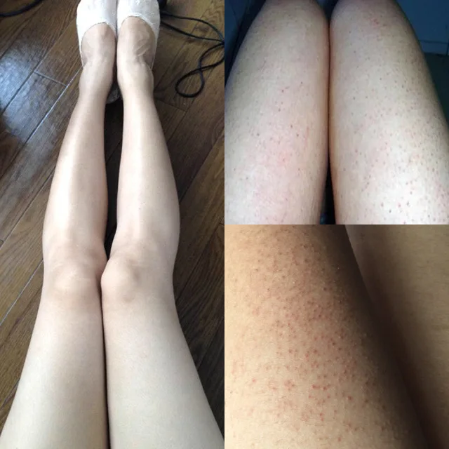 

Malic acid Treatment Body ichthyosis Leg keratosis follicularis Cream Natural thigh fish scale skin disease body milk 50g