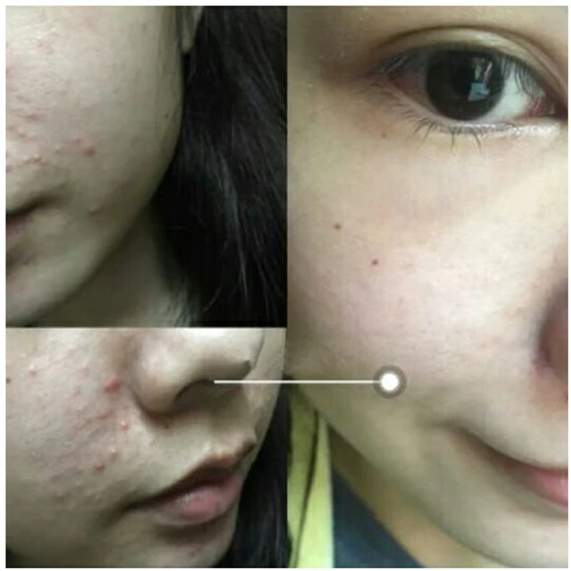 Salicylic Acid 2% Salicylic Acid + Witch Hazel Oil Essence 30ML Clear cuticles acne and pores Skin Care 4