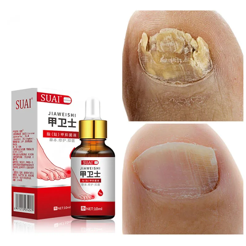 Fungal Nail Treatment