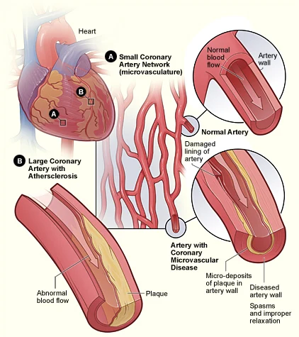 angina-microvascular
