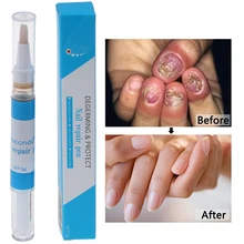 Onychomycosis Paronychia против грибков, китайский травяной носок, Лечение грибка для ногтей, ручка для лечения грибка для ногтей