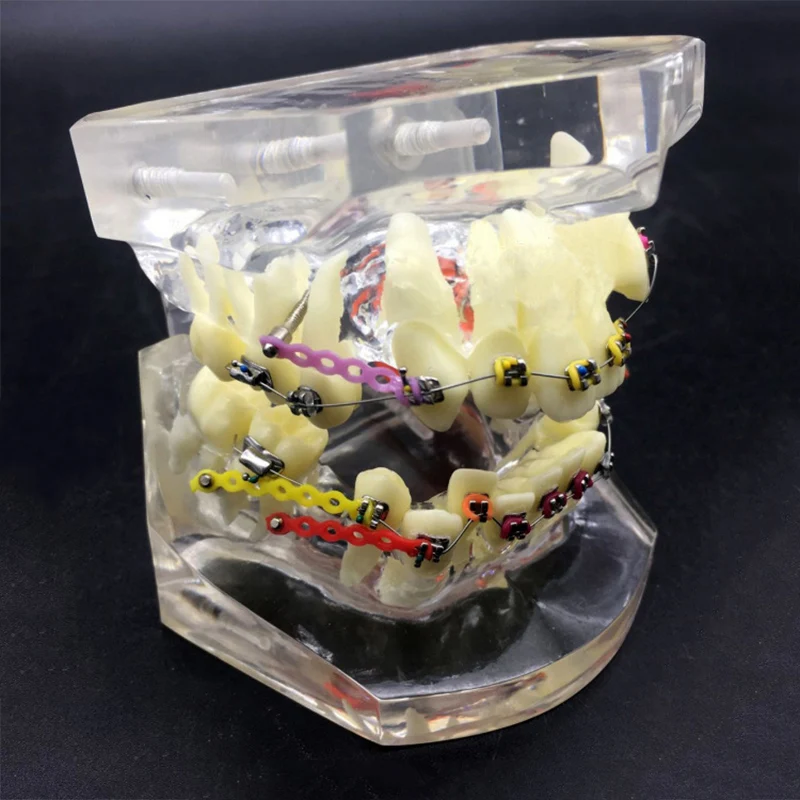 Стоматологическая Ортодонтическая модель прозрачная коррекция неисправности дисплей модели с кронштейном лигатурная проволока Стоматологическая модель зубов