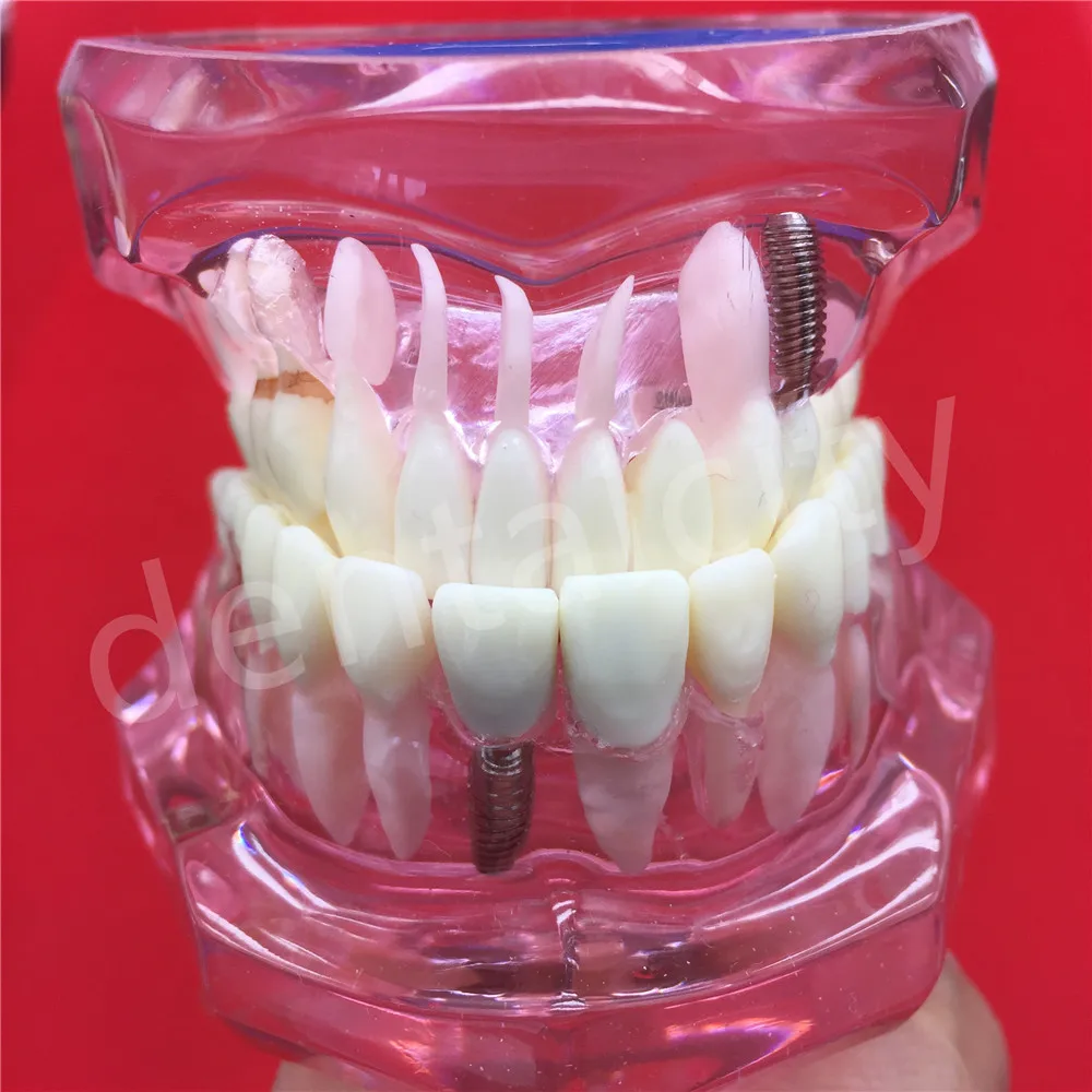 Новая модель зубного импланта с реставрационным мостом для протеза|teeth model|dental