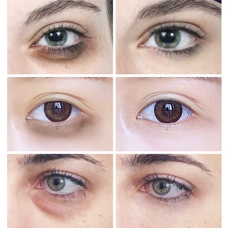 brighten skin around eyes