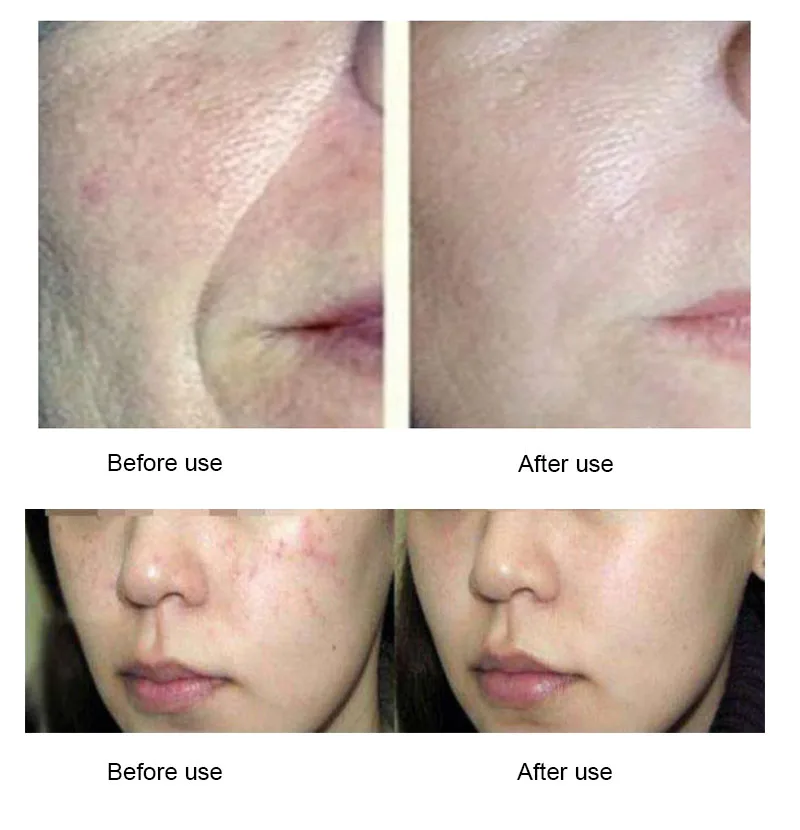 

Natural Organic nutrients DMAE & MSM + Vitamin E, firming and anti-wrinkle, acne scars, wrinkles,Essence cream 30ml