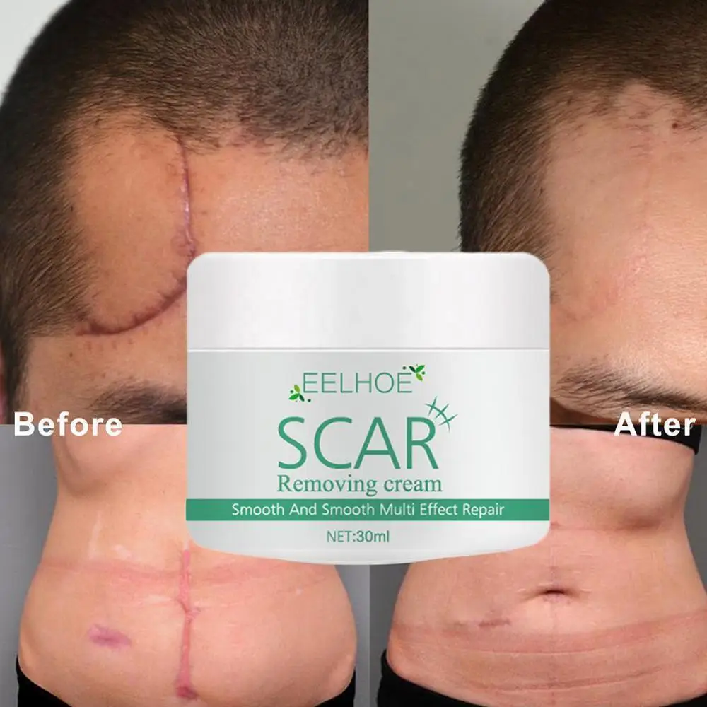 Removal Scar Cream Face Pimples Scar Stretch Marks Removal Acne
