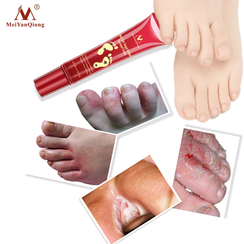 Herbal Foot Treatment Anti Fungal Infection Onychomycosis Paronychia Effective Toe Fungus Treatment Feet Repair Cream foot care5