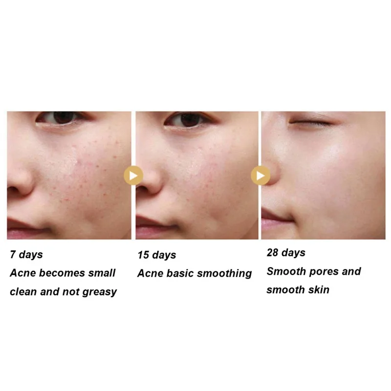 Софора желтоватая мыло увлажняющее анти-клещи анти-acnes крем для очищения пор носа Отбеливающее мыло ручной работы Новинка