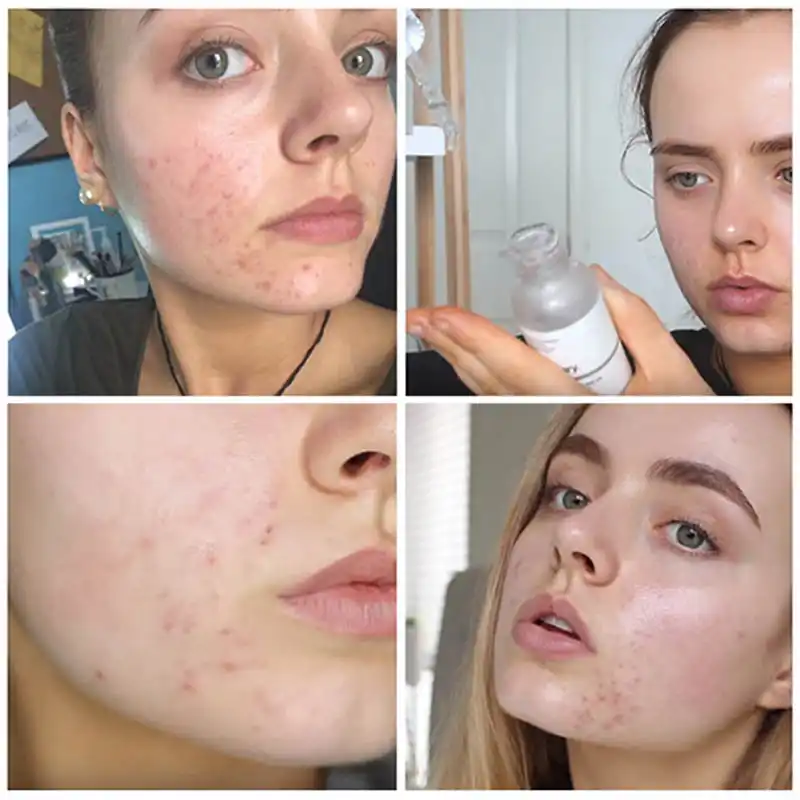 the ordinary peeling solution on pimples