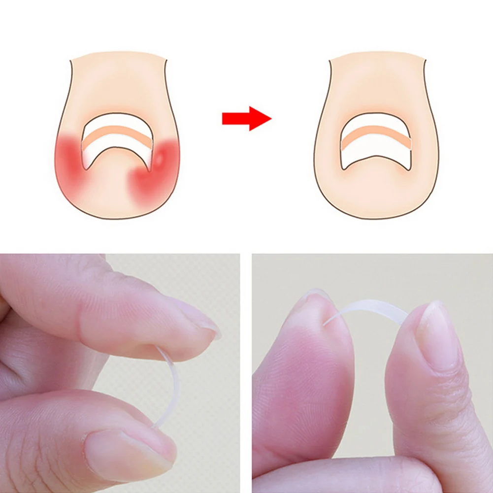 Новые 12 шт./бутылка для вросших ногтей инструмент для коррекции индента ногтей ног Педикюр эластичная заплатка CLA88