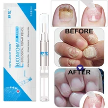 Nail Fungus Treatment rehydration solution Liquid Anti Fungal Finger Toe Nails Care Restore normal nail Glossy shape 3ml