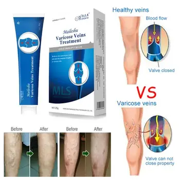 

Varicose Veins Treatment Cream Effective cure Vasculitis Phlebitis Spider Veins Pain Varicosity Angiitis ointment Health Care