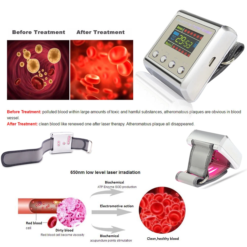 Бытовой 650 нм лазер физиотерапия запястье диод LLLT для лечения диабета гипертония часы для диабетиков терапия синусита